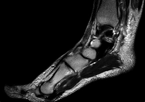 Mri Picture Showing Avulsion Of Tibialis Anterior Download