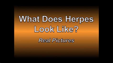 Early Signs Of Genital Herpes Pictures Youtube