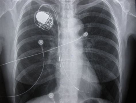 Early Complications After Pacemaker Implantations Intechopen