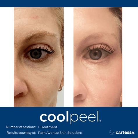 Tetra Coolpeel Co2 Laser Milpitas Ca And Burlingame Ca Simon Lee Md