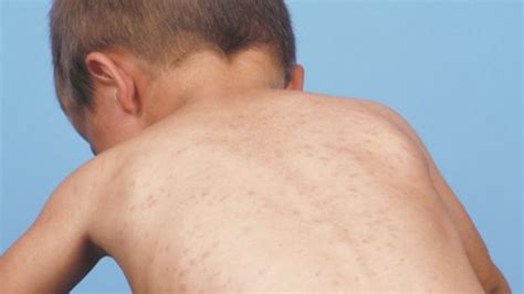 If it is going to arise, it usually appears about a week after your vaccine, dr. Measles rise: MMR jab take up targets not hit in Wales ...
