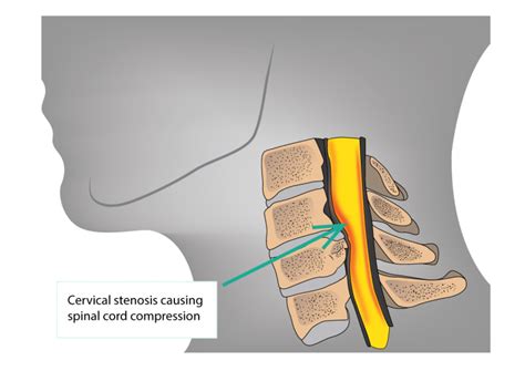 Cervical Stenosis And Cervical Myelopathy Dr Yu Chao Lee