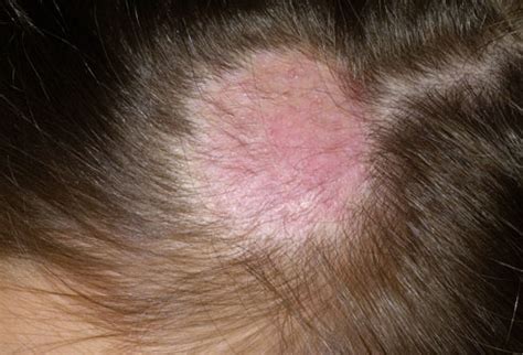 Cat skin hot spots may also be referred to as pyotraumatic dermatitis and acute moist dermatitis. Itchy Paws: Ringworm!: the truth in your cats and dogs