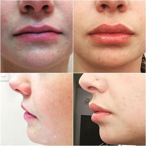 Before And After Juvederm Get Does Plump Lips For Summer Poutylips