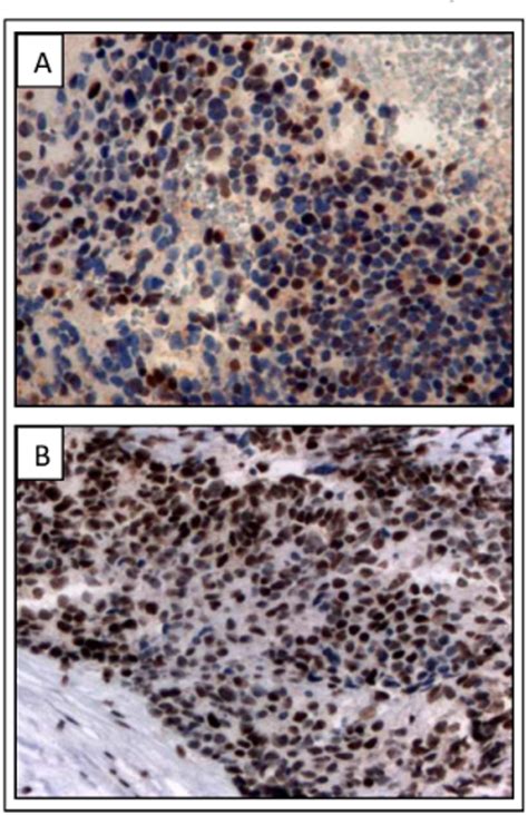 Immunohistochemical P53 Staining On Pr337h Positive Nb Tumors A B