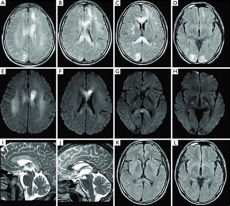 Initial Mri Taken On Admission Abcd Flair Images Show Multiple