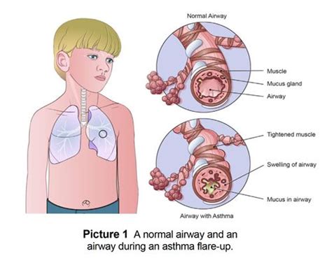 asthma and reactive airway disease symptoms and treating flare ups reactive airway disease