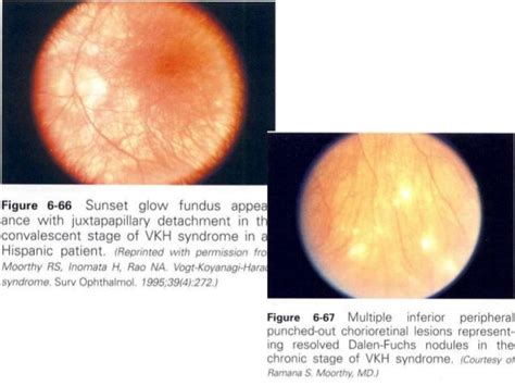 Uveitis In Behcet Disease And Vkh