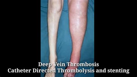 Deep Vein Thrombosis Dvt Treatment Catheter Directed Thrombolysis