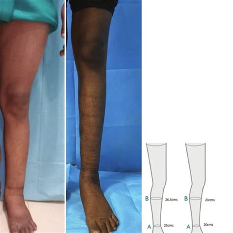 A Preoperative Photograph Of Grade 2 Lymphedematous Left Leg Shows