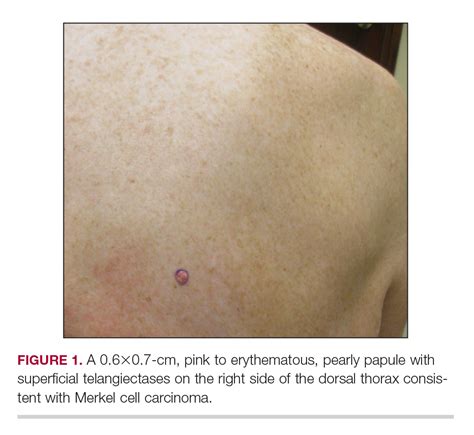 Merkel Cell Carcinoma In A Patient With A History Of Psoriasis Mdedge