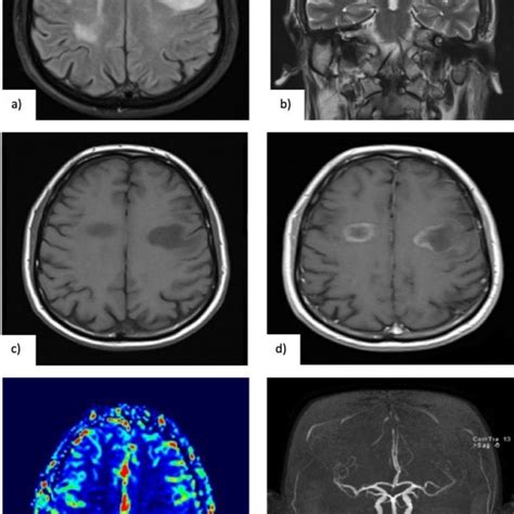 A B Brain Mri 14 06 2017 Showing White Matter Lesions