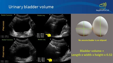 Bladder Ultrasound Calculation Of Volume Nephropocus