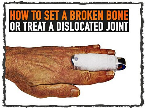 how to set a broken bone or treat a dislocated joint survival before it s news