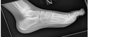 Severs Disease An Underdiagnosed Foot Injury In The Pediatric