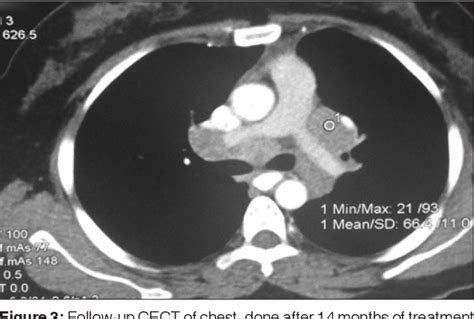 Figure 3 From A Rare Case Of Sarcoidosis With Necrotizing Mediastinal