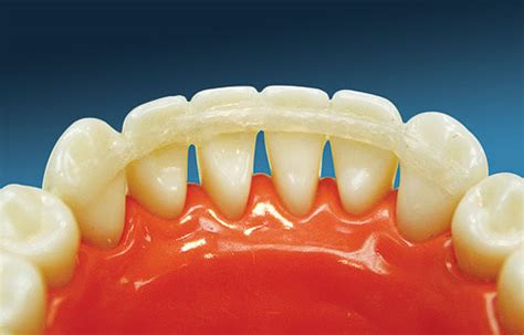 Periodontal Splinting