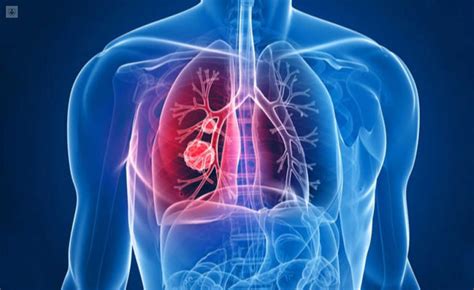 Embolia Pulmonar Qu Es S Ntomas Y Tratamiento Top Doctors