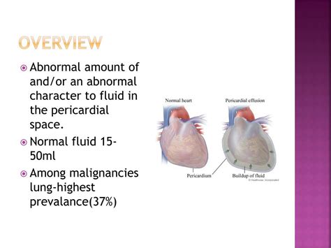 PPT Pericardial Effusion And Cardiac Tamponade PowerPoint
