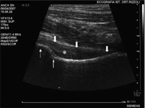 Ultrasound Imaging Of Hip Joint A 135 Mhz Multifrequency Linear
