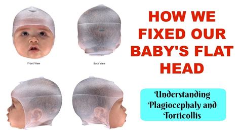 How To Treat And Prevent A Babys Flat Head Understanding