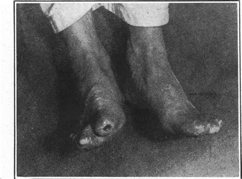 Trench Foot And Immersion Foot Nejm