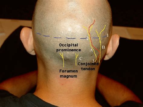 Greater Occipital Nerve And Artery