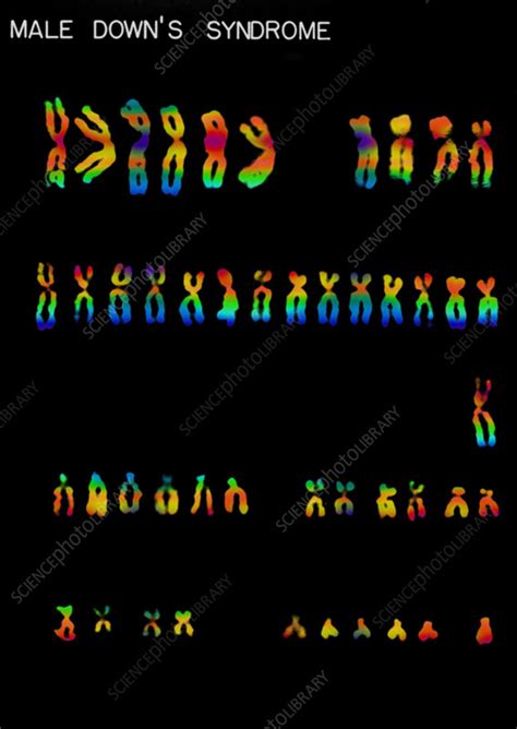 Downs Syndrome Karyotype Stock Image C0220522 Science Photo Library