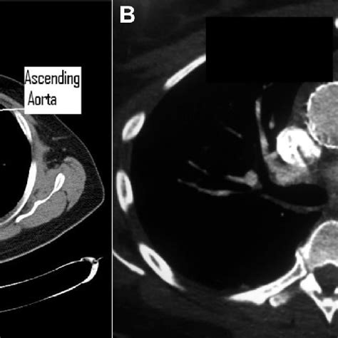 Computed Tomography Scans Showing Ascending Aortic Aneurysm Before