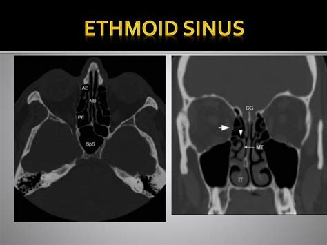 Paranasal Sinuses X Ray Anatomy Tondahtyuimcfall