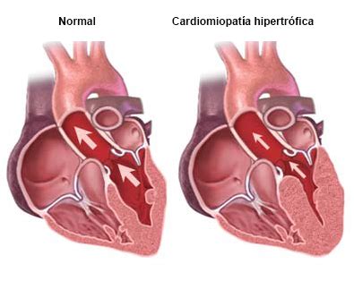 Cardiomiopatía hipertrófica Boston Scientific