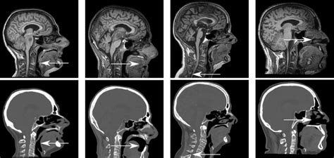 Examples Showing Local Misalignment Between Mr And Ct Images After