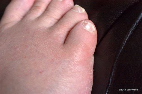 This initial stage is followed by suppression of the immune system. My sepsis incident | Speed River Journal