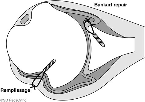 Arthroscopic Bankart Repairs With And Without Remplissage In Recurrent
