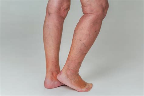 What Is Venous Or Varicose Eczema Specialist Vein Health