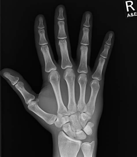 Normal Hand Radiograph Radiology Case Radiopaedia Org