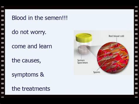 Blood In The Semen Do Not Worry Come And Learn About The Causes Symptoms And Treatment YouTube