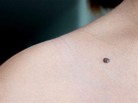 Weird Signs Of Skin Cancer That Are Super Hard To Spot Business Insider