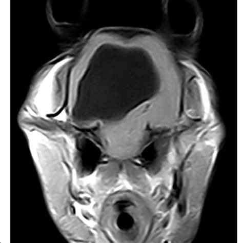 Axial T1 Magnetic Resonance Image Showing A Hypointense Lesion