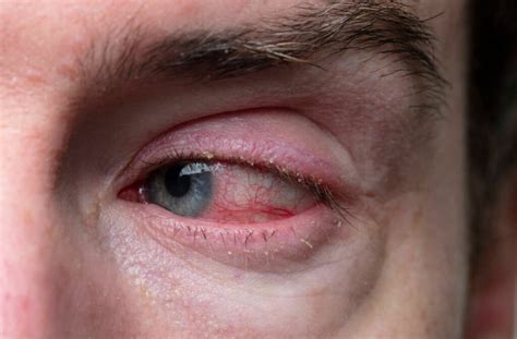 Eyelid Diseases