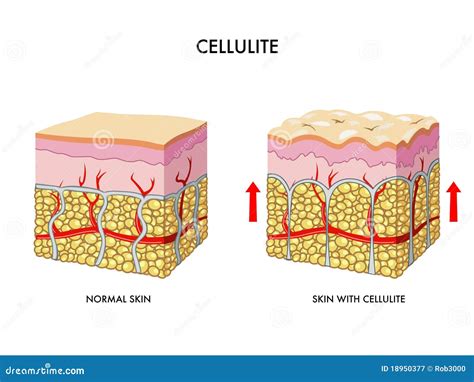 Cellulite Vector Illustration 31623424