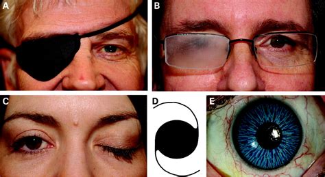 Intractable Diplopia A New Indication For Corneal Tattooing British