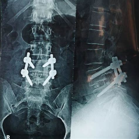 The Post Op X Ray Ls Spine Ap Lateral At 3 Months With Posterior