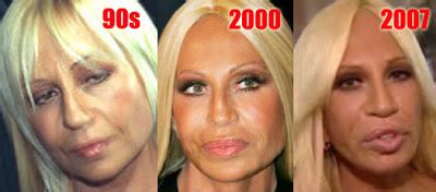 Donatella Versace Plastic Surgery Before And After Nose Job Facelift