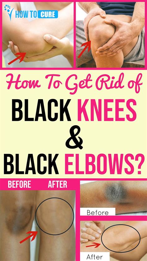 How To Get Rid Of Black Knees And Black Elbow Video Video Dark