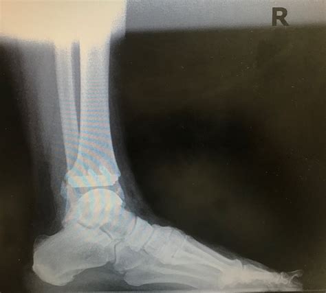 Strash Foot And Ankle Care Total Ankle Replacement At Strash Foot