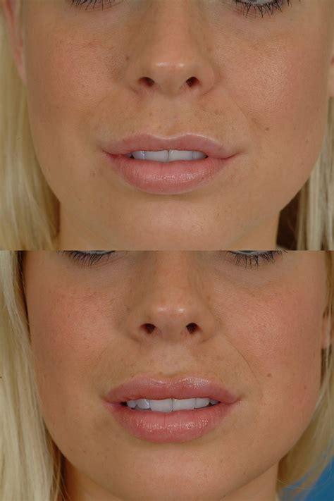 Lip Augmentation Before And After Photos Dr Bassichis