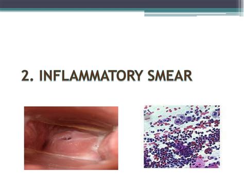 Ppt Management Of Abnormal Pap Smear Powerpoint Presentation Free Download Id 1933804