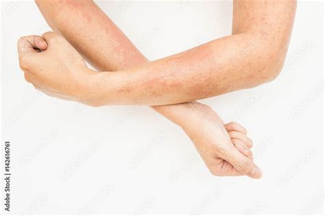 Skin Rashes Allergies Contact Dermatitis Allergic To Chemicals