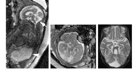 Joubert Syndrome And Related Cerebellar Disorder Jsrd At 28 Weeks